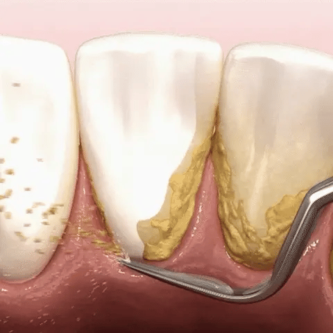 باقة ٣ - جهاز إزالة الجير
